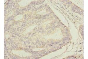 Immunohistochemistry of paraffin-embedded human endometrial cancer using ABIN7169694 at dilution of 1:100 (STAM2 antibody  (AA 376-525))