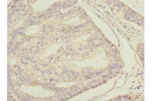 Immunohistochemistry of paraffin-embedded human endometrial cancer using ABIN7169694 at dilution of 1:100