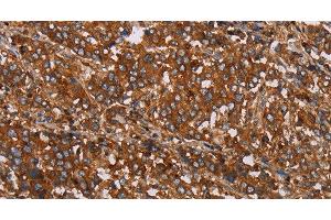 Immunohistochemistry of paraffin-embedded Human liver cancer tissue using MFAP5 Polyclonal Antibody at dilution 1:40 (MFAP5 antibody)
