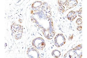 Formalin-fixed, paraffin-embedded human Breast Carcinoma stained with SM-MHC Monoclonal Antibody (SMMS-1). (MYH11 antibody)