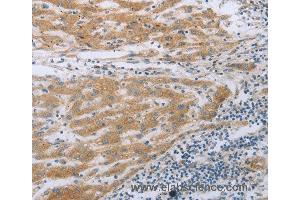 Immunohistochemistry of Human liver cancer using TNK2 Polyclonal Antibody at dilution of 1:70 (TNK2 antibody)