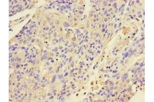 Immunohistochemistry of paraffin-embedded human cervical cancer using ABIN7157424 at dilution of 1:100 (KRT4 antibody  (AA 1-534))