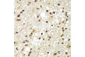 Immunohistochemistry of paraffin-embedded human brain cancer using ZNF20 antibody (ABIN5975115) at dilution of 1/100 (40x lens). (ZNF20 antibody)