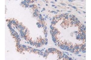 Detection of AKAP11 in Human Prostate Tissue using Polyclonal Antibody to A Kinase Anchor Protein 11 (AKAP11)