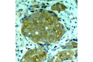 Immunohistochemistry of paraffin-embedded human breast carcinoma using Phospho-NFKB1-S932 antibody (ABIN2988211). (NFKB1 antibody  (pSer932))