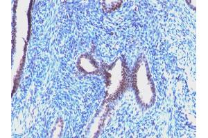 Formalin-fixed, paraffin-embedded human Endometrial Carcinoma stained with Cyclin B1 Mouse Monoclonal Antibody (CCNB1/1098). (Cyclin B1 antibody)