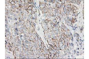 Immunohistochemical staining of paraffin-embedded Adenocarcinoma of Human breast tissue using anti-ANAPC2 mouse monoclonal antibody. (ANAPC2 antibody)