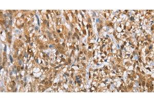 Immunohistochemistry of paraffin-embedded Human esophagus cancer tissue using MMP12 Polyclonal Antibody at dilution of 1:60 (MMP12 antibody)