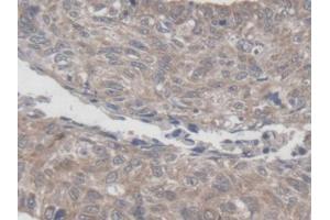 DAB staining on IHC-P; Samples: Human Lung cancer Tissue (MRPL1 antibody  (AA 147-285))
