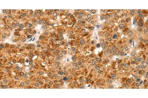 Immunohistochemistry of paraffin-embedded Human liver cancer using CCS Polyclonal Antibody at dilution of 1:35 (Superoxide dismutase copper chaperone antibody)