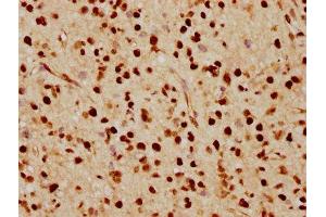 IHC image of ABIN7127502 diluted at 1:70 and staining in paraffin-embedded human glioma cancer performed on a Leica BondTM system. (Recombinant FTO antibody)