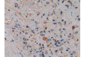 Detection of NGAL in Human Prostate cancer Tissue using Polyclonal Antibody to Neutrophil gelatinase-associated lipocalin (NGAL) (Lipocalin 2 antibody  (AA 21-198))