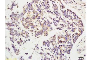 Formalin-fixed and paraffin embedded human rectal carcinoma labeled with Rabbit Anti CYP2E1 Polyclonal Antibody, Unconjugated (ABIN707141) at 1:200 followed by conjugation to the secondary antibody and DAB staining (CYP2E1 antibody  (AA 401-493))