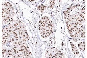 ABIN6268903 at 1/200 staining human Breast cancer tissue sections by IHC-P. (P18 INK antibody)
