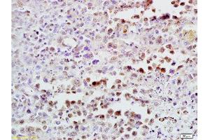Formalin-fixed and paraffin embedded mouse lymphoma tissue labeled with Anti-CDK4 Polyclonal Antibody , Unconjugated at 1:300, followed by conjugation to the secondary antibody and DAB staining (CDK4 antibody  (AA 241-303))
