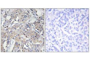 Immunohistochemistry analysis of paraffin-embedded human breast carcinoma tissue using COL6A3 antibody. (COL6a3 antibody  (Internal Region))