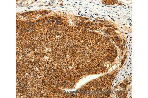 Immunohistochemistry of Human lung cancer using TRPC6 Polyclonal Antibody at dilution of 1:50 (TRPC6 antibody)