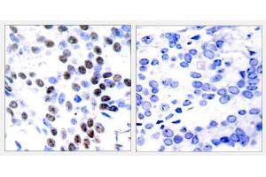 Immunohistochemical analysis of paraffin-embedded human breast carcinoma tissue using c-Jun (Ab-93) antibody (E021022). (C-JUN antibody)