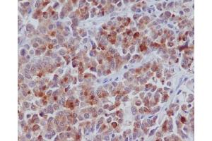 Immunohistochemical analysis of paraffin-embedded human colon cancer, using Cyclin B1 Antibody. (Recombinant Cyclin B1 antibody)