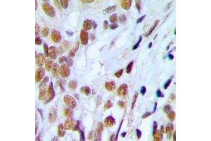 Immunohistochemical analysis of Lupus La (pS366) staining in human prostate cancer formalin fixed paraffin embedded tissue section. (Lupus La (C-Term), (pSer366) antibody)