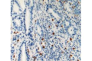 IHC-P analysis of stomach cancer tissue, with DAB staining. (LAMC2 antibody  (AA 416-602))