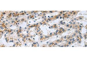 Immunohistochemistry of paraffin-embedded Human liver cancer tissue using GHRHR Polyclonal Antibody at dilution of 1:40(x200) (GHRHR antibody)