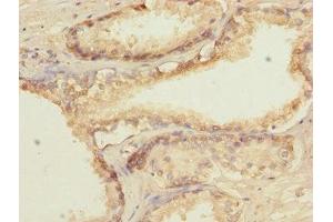Immunohistochemistry of paraffin-embedded human prostate cancer using ABIN7172660 at dilution of 1:100 (GTF2A2 antibody  (AA 1-109))