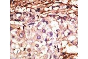 IHC analysis of FFPE human breast carcinoma tissue stained with the PRMT6 antibody