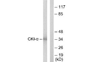 Immunohistochemistry analysis of paraffin-embedded human lung carcinoma tissue using CKI-α antibody. (CSNK1A1 antibody)