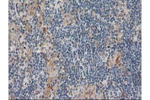 Immunohistochemical staining of paraffin-embedded Human lymphoma tissue using anti-CXorf26 mouse monoclonal antibody. (CXorf26 antibody)