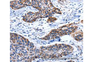 Immunohistochemistry of Human esophagus cancer using AQP8 Polyclonal Antibody at dilution of 1:75