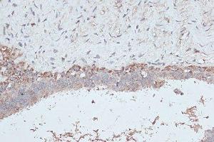 Immunohistochemistry of paraffin-embedded human breast cancer using MAP1LC3B antibody. (LC3B antibody)