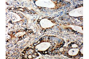 Anti-Integrin alpha 3 antibody,  IHC(P) IHC(P): Human Intestinal Cancer Tissue (ITGA3 antibody  (N-Term))