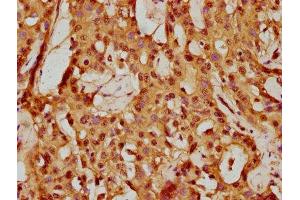 IHC image of ABIN7145298 diluted at 1:150 and staining in paraffin-embedded human liver cancer performed on a Leica BondTM system. (BCL2L1 antibody  (AA 19-127))