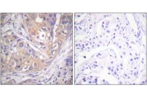 Immunohistochemistry analysis of paraffin-embedded human breast carcinoma, using Lck (Phospho-Tyr505) Antibody. (LCK antibody  (pTyr505))