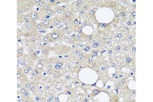 Immunohistochemistry of paraffin-embedded Human liver cancer using AFP Monoclonal Antibody at dilution of 1:12. (alpha Fetoprotein antibody)