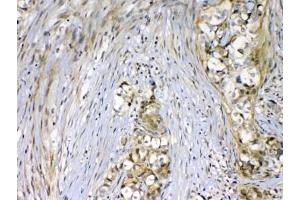 IHC testing of FFPE human breast cancer tissue with VEGFR2 antibody at 1ug/ml.