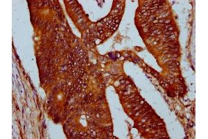 IHC image of ABIN7169703 diluted at 1:400 and staining in paraffin-embedded human colon cancer performed on a Leica BondTM system. (SIRPB1 antibody  (Isoform 3))