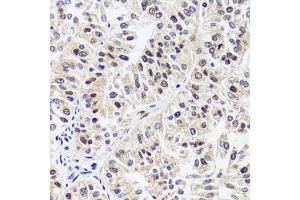 Immunohistochemistry of paraffin-embedded human uterine cancer using C antibody (ABIN7266546) at dilution of 1:100 (40x lens). (CAND1 antibody  (AA 750-980))