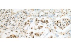 Immunohistochemistry of paraffin-embedded Human breast cancer tissue using SEPHS1 Polyclonal Antibody at dilution of 1:80(x200) (SEPHS1 antibody)