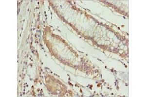 Immunohistochemistry of paraffin-embedded human colon cancer using ABIN7151996 at dilution of 1:100 (ERLIN2 antibody  (AA 212-339))