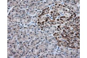 Immunohistochemical staining of paraffin-embedded Adenocarcinoma of colon tissue using anti-RC203219 mouse monoclonal antibody. (ACSBG1 antibody)