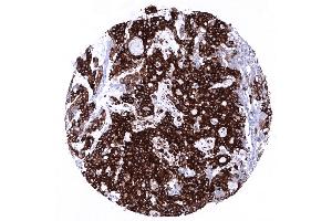 Stomach Strong MUC5AC immunostaining in an adenocarcinoma of the stomach 100 of tumor cells (Recombinant MUC5AC antibody)