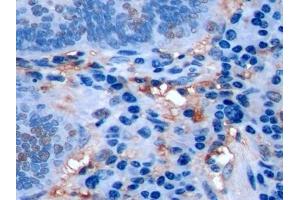 Detection of Ki-67 in Human Colorectal cancer Tissue using Polyclonal Antibody to Ki-67 Protein (Ki-67) (Ki-67 antibody  (AA 3088-3235))