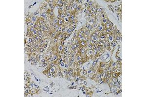 Immunohistochemistry of paraffin-embedded human prostate cancer using ARHGEF11 antibody.