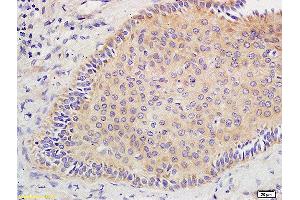 Formalin-fixed and paraffin embedded human oral squamous cell carcinoma tissue labeled with Anti CD44V10 Polyclonal Antibody, Unconjugated  at 1:400 followed by conjugation to the secondary antibody and DAB staining. (CD44v10 (AA 218-227) antibody)