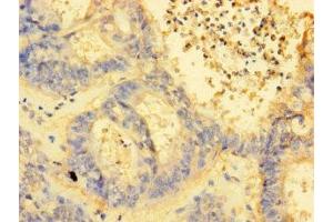 Immunohistochemistry of paraffin-embedded human endometrial cancer using ABIN7142407 at dilution of 1:100 (MRPL38 antibody  (AA 35-380))