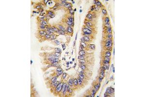 Formalin-fixed and paraffin-embedded human lung carcinoma tissue reacted with PTEN antibody (N-term) (ABIN6242545 and ABIN6579042) , which was peroxidase-conjugated to the secondary antibody, followed by DAB staining. (PTEN antibody  (N-Term))