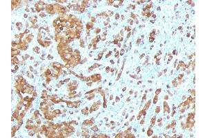 Formalin-fixed, paraffin-embedded human Melanoma stained with Melan-A / MART-1 Mouse Monoclonal Antibody (MLANA/788). (MLANA antibody)