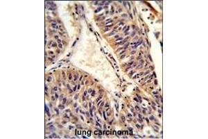 Formalin-fixed and paraffin-embedded human lung carcinoma reacted with ALG14 Antibody (Center), which was peroxidase-conjugated to the secondary antibody, followed by DAB staining.